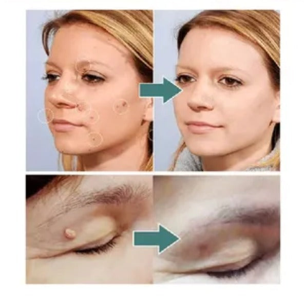 FormuClear™ - Elimina verrugas sin dolor y seguro + ENVIO GRATIS