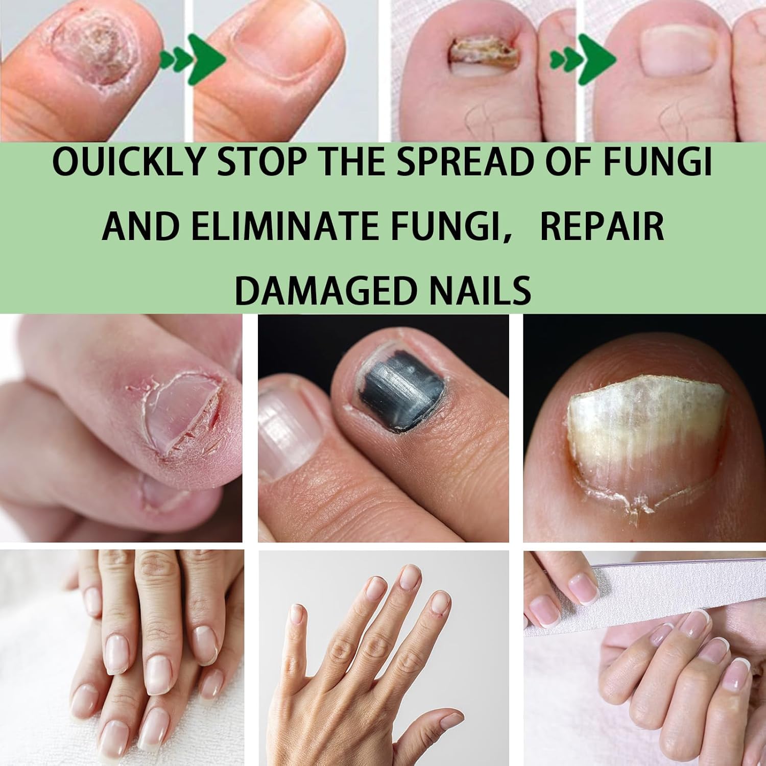 ACEITE EN GOTAS PARA HONGOS - UÑAS DE PIES Y MANOS + ENVIO GRATIS